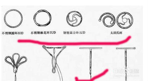 最新节育器技术及其应用概述